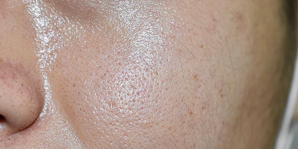 O desafio da pele oleosa: dicas e cuidados essenciais