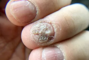 Elimine de vez o fungo na unha